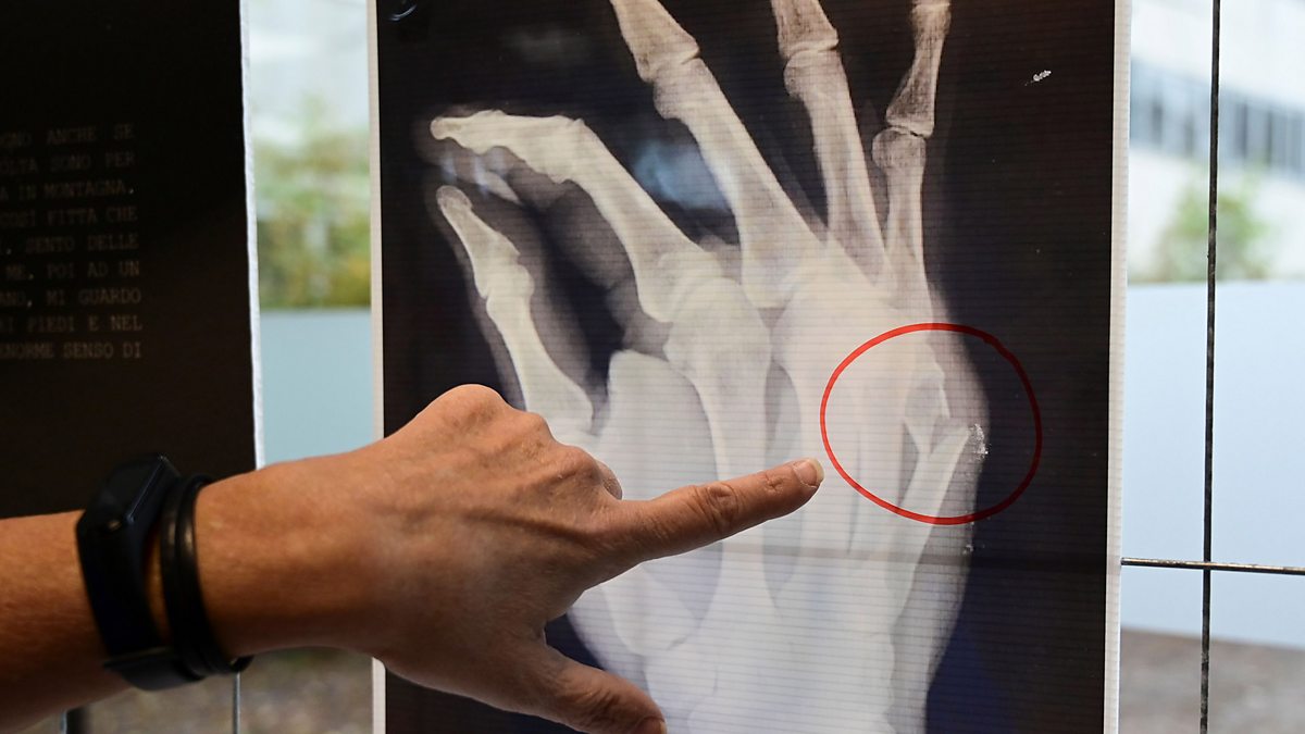 BBC World Service Science In Action, Bone repair from Covid19