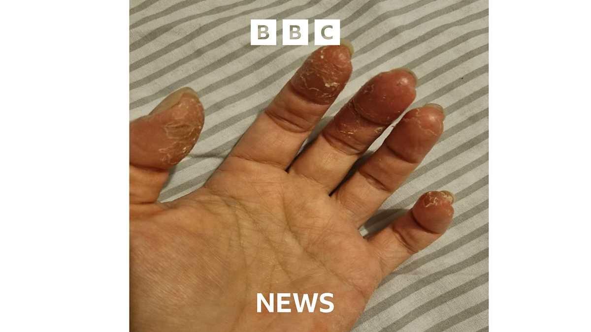 BBC Gel nail polish linked to life changing allergies