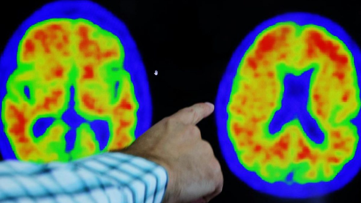 BBC World Service - Newshour, New Alzheimer's Drug Effective In Slowing ...