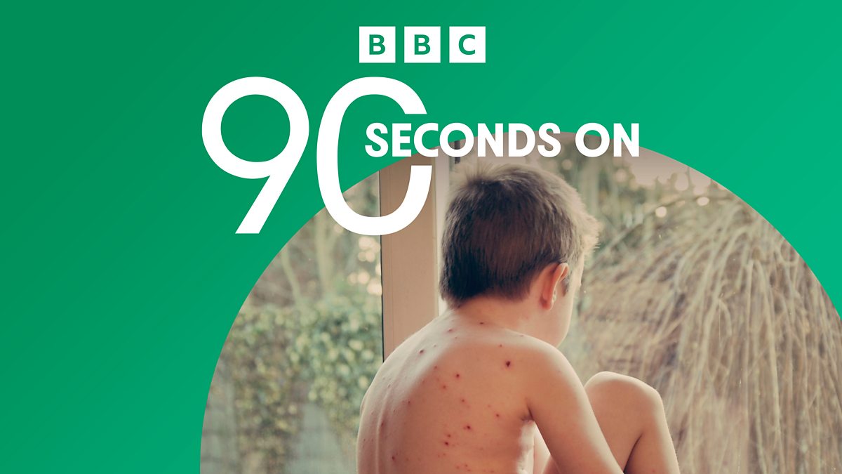 BBC 90 Seconds On Will ministers approve a chickenpox jab?