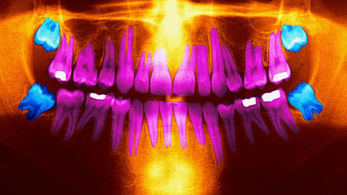 Bbc world service crowdscience why do we have wisdom teeth 