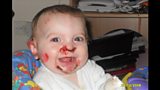 Epidermolysis bullosa parents work to raise its profile