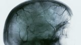 I WAS AWAKE DURING BRAIN SURGERY :: MARC ROBERTS