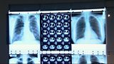 Tackling drug-resistant TB in London