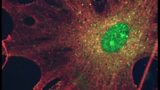 Brain tumour research