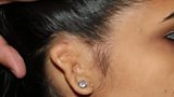 3D printed ears for disfigured children