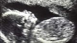 Abortion