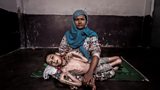 Sameer, who is 16 years old and has cerebral palsy, was born to gas-affected parents