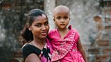 Leprosy is not a disease of the past