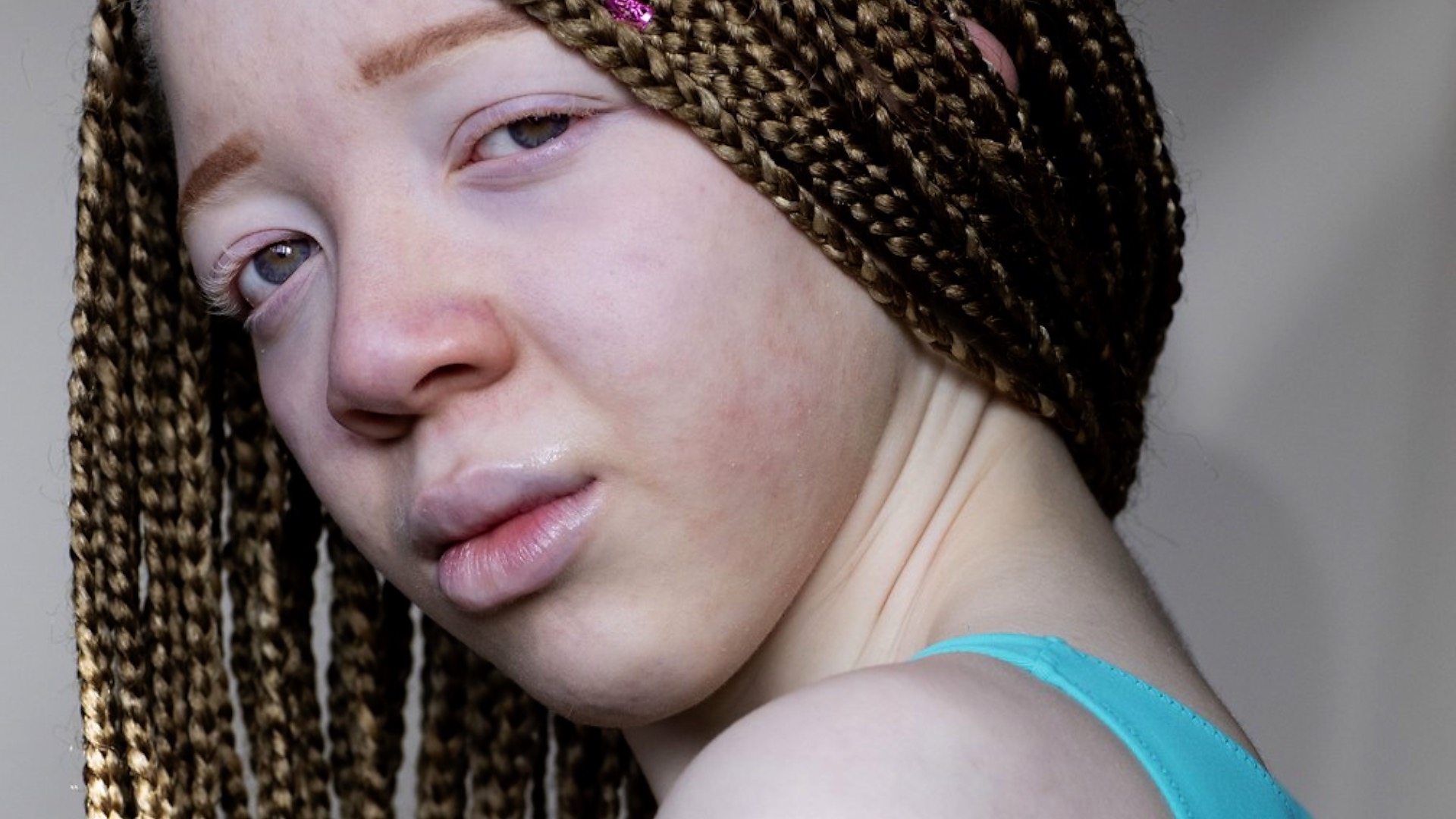 Teenage Albino Model I M Thankful For My Skin Tone c News