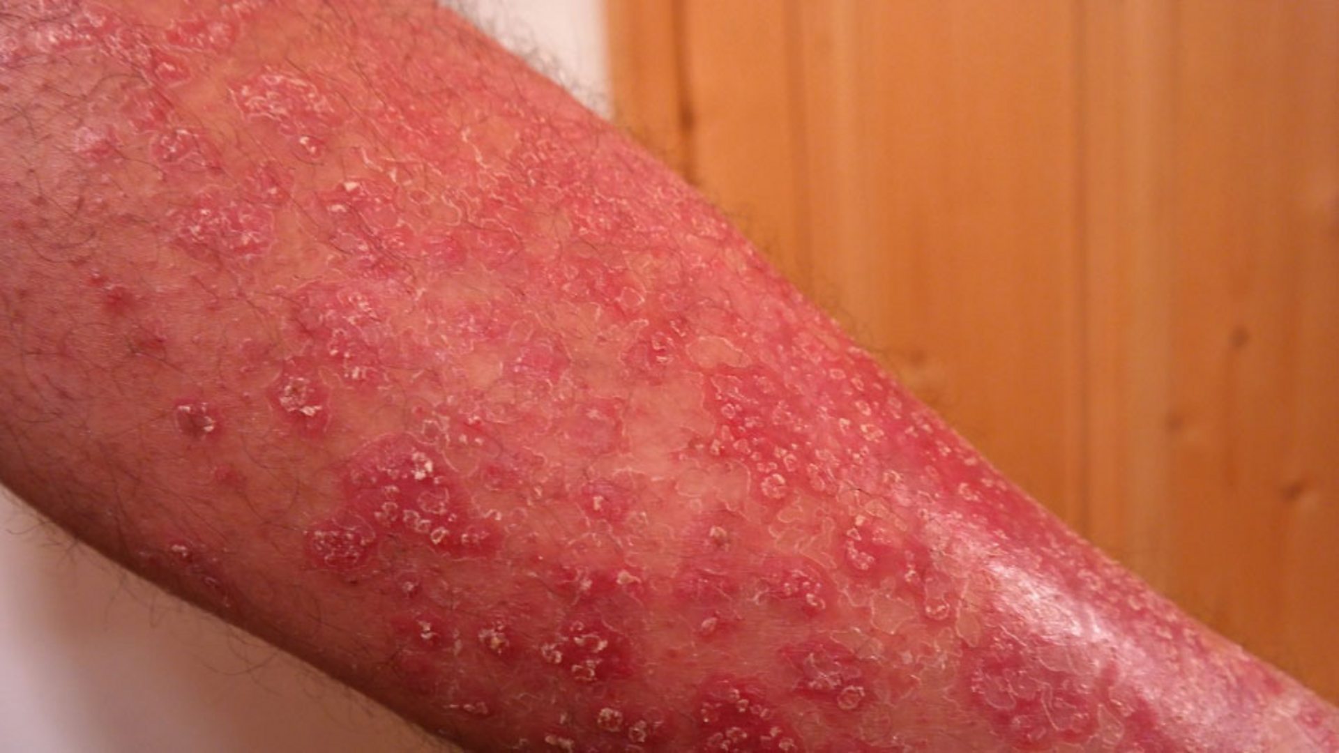 Psoriasis - Symptoms - NHS