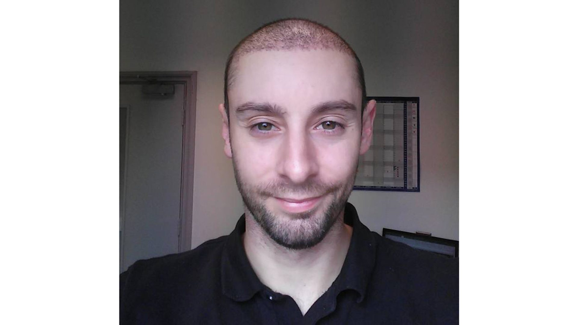 man who had hair transplant