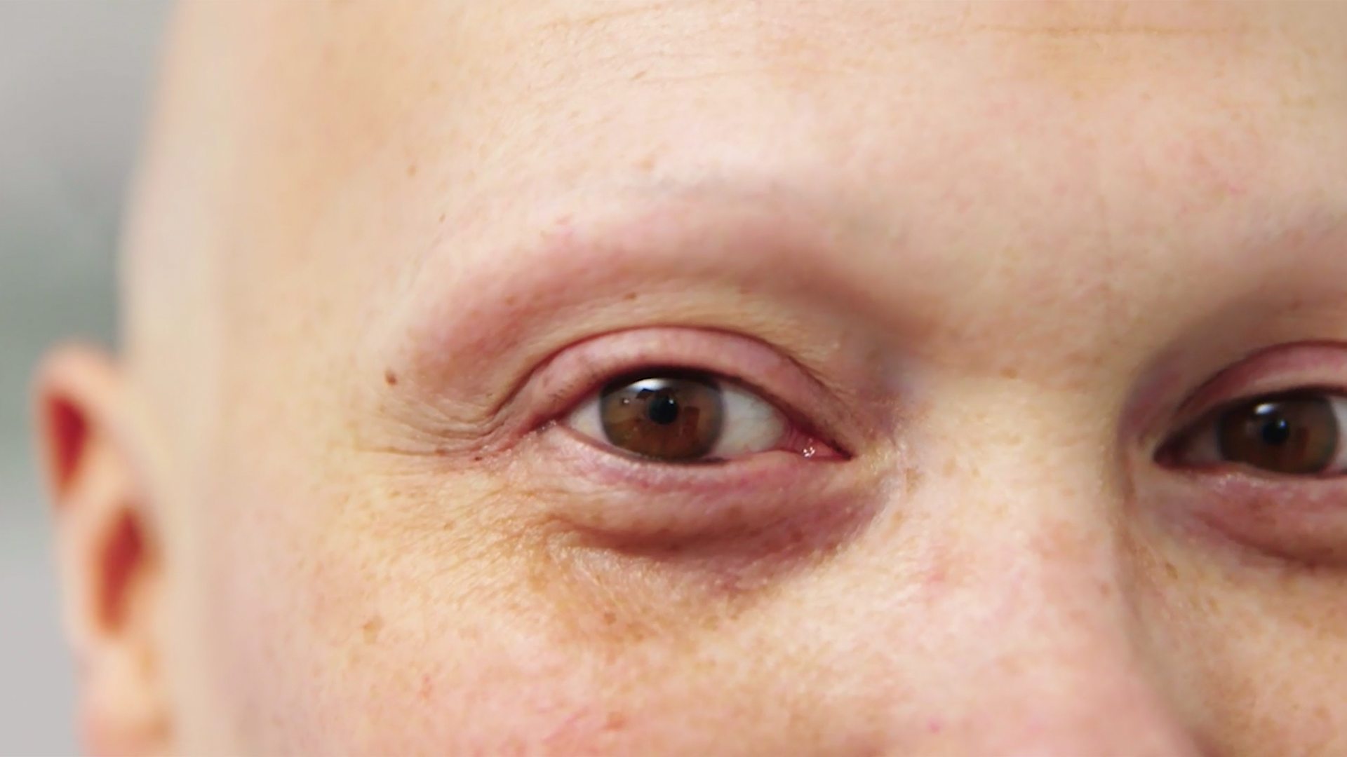 Alopecia caused Carly to lose her eyebrows too