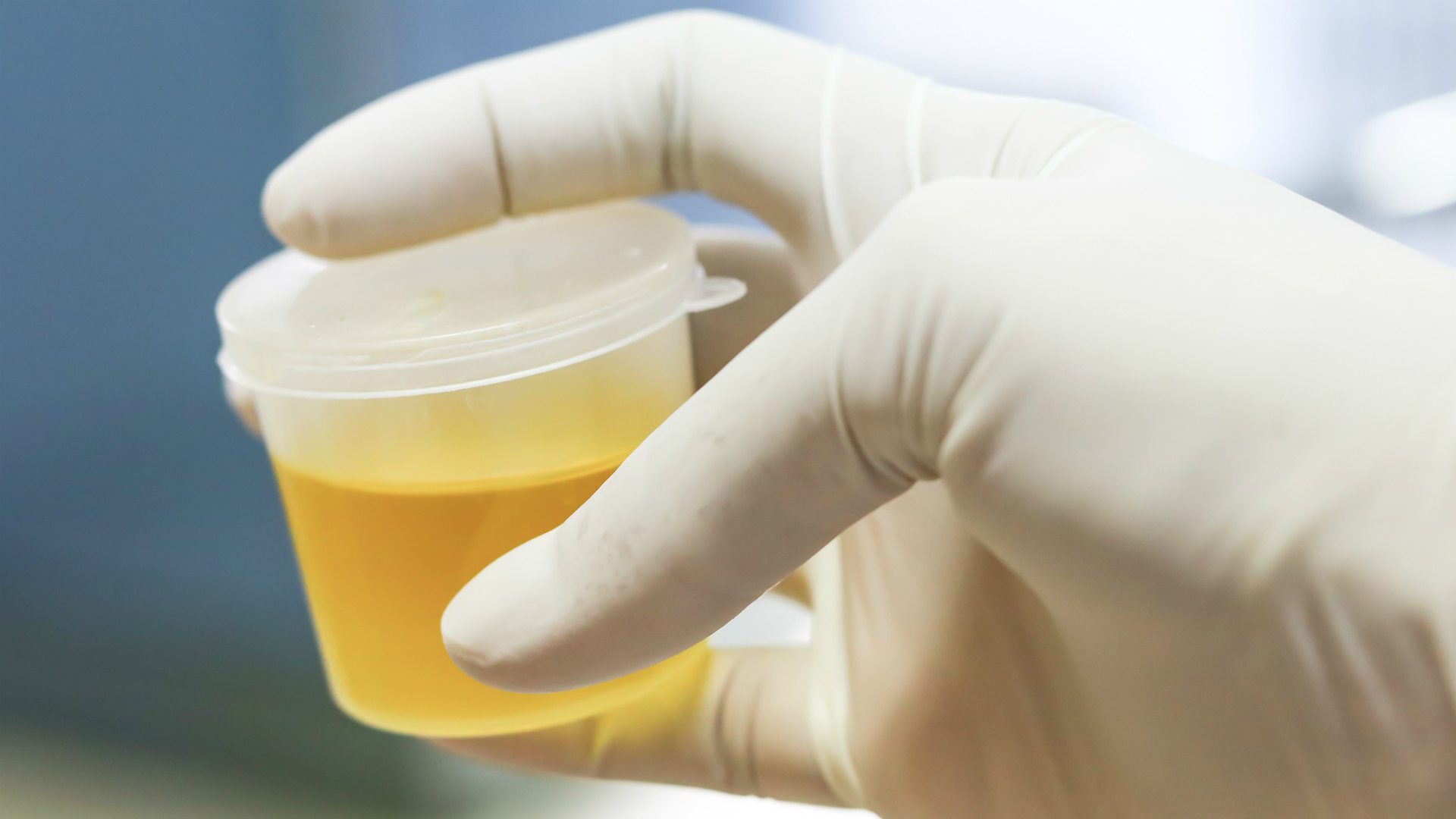 Urine sample