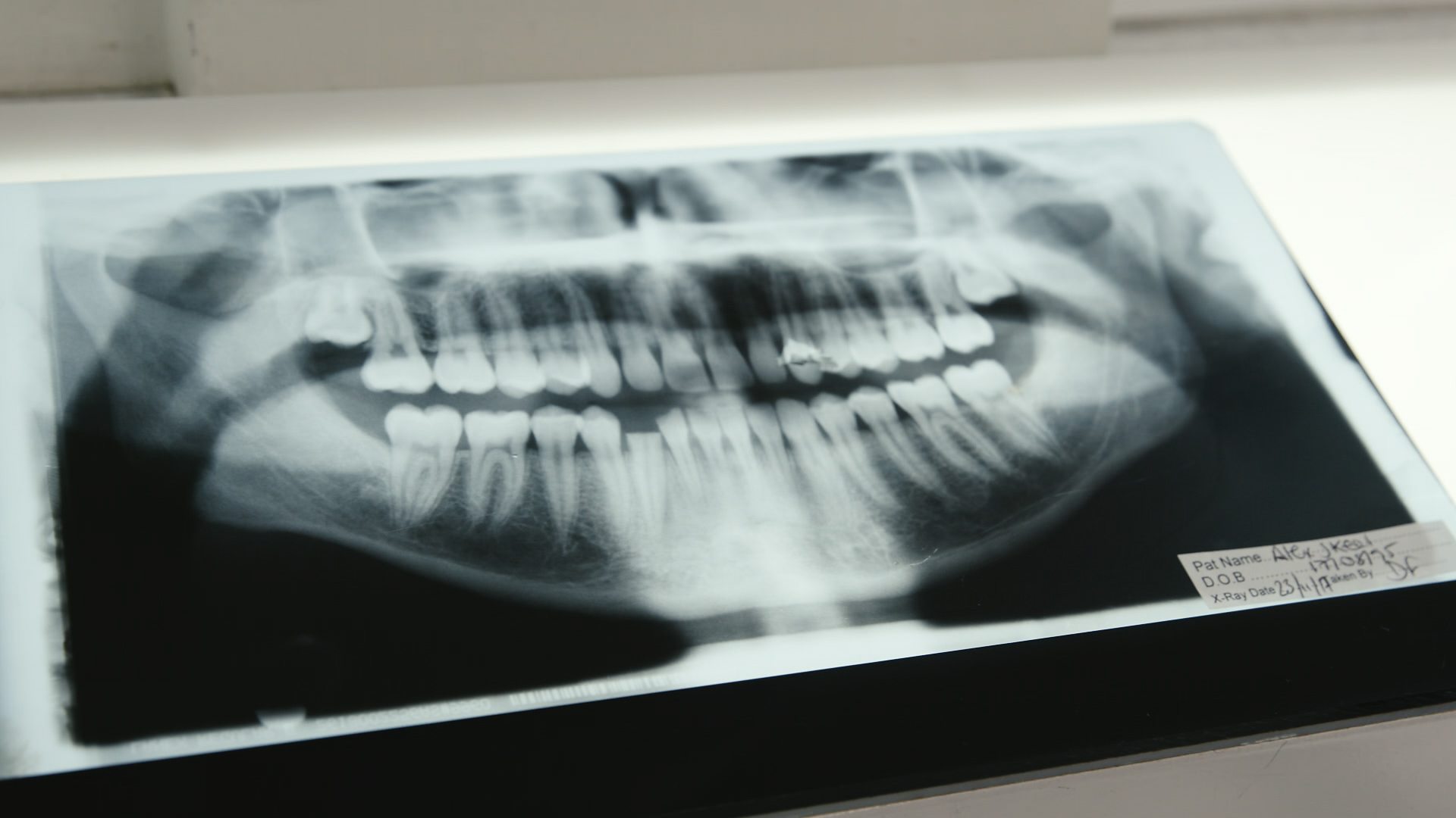 An x-ray of Alex's mouth showing his broken teeth