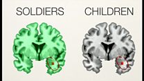 虐待受けた子どもとPTSD兵士の脳が類似=研究