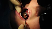 Tooth decay in the under-fives - a good news story