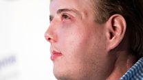 The 'third face' of a transplant patient