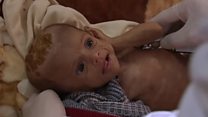 Children on the brink of famine in Yemen
