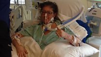 Woman survives 6 days with no lungs