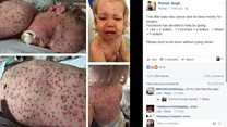 Mum: 'My kid’s chicken pox pics used in cancer scam’