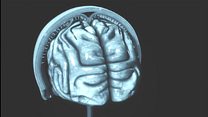 What is concussion and can you stop it?