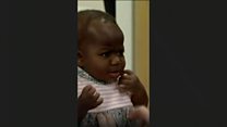 Baby's surgery to remove parasitic twin