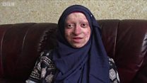 Assya Shabir, lahir dengan kondisi kulit melepuh