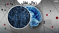 امیدی تازه برای توقف پارکینسون و آلزایمر