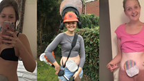 Stoma patient raising profile of Chron's