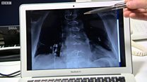 Schoolboy helps heart surgeons