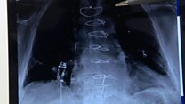 Sixteen-year-old's heart surgery idea