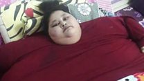 آپریشن سے وزن میں 242 کلو کی کمی