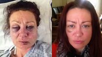 Why I took selfies of vicious injuries from ex-boyfriend