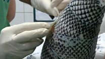 Can fish skin help treat burns?