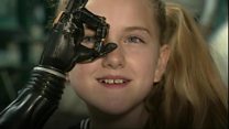 3D printed bionic hands