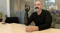 Бионическая рука: как технологии меняют жизнь