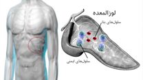 روشی جدید برای درمان دیابت نوع اول