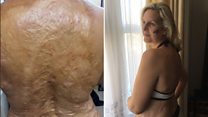 Me and my scar: It took me 45 years to love my body