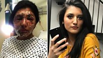 Resham Khan 'pities' man who threw acid on her