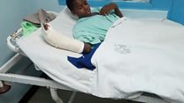 Kijana afanikiwa kupandikizwa mkono wake upya Kenya