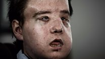 First double face transplant patient 'well'