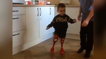Child amputee walks unaided for first time