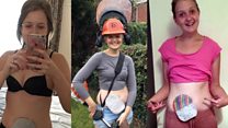 Stoma patient raising profile of Crohn's