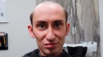 'I lost my hair when my mum died'
