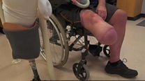 'I lost my leg to type 2 diabetes'
