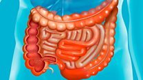 Idwara ya gastroenterite iterwa no kurya ibyanduye