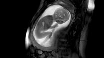 Las increíbles imágenes del corazón de un bebé latiendo dentro de la barriga de su madre