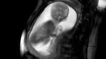 له زېږېدو مخکې د ژوند ژغورنه