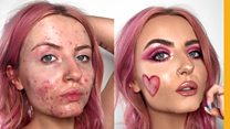 How I got my acne glow